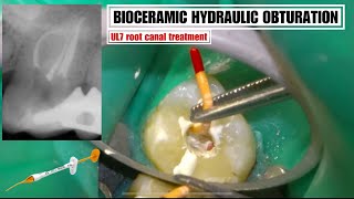 RCT hydraulic bioceramic obturation Upper Molar dentist [upl. by Tayyebeb]