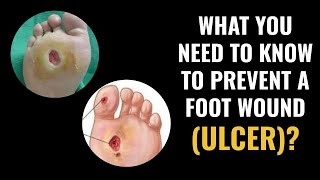 What you need to know to prevent a foot wound ulcer [upl. by Adnara]