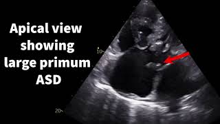 Transitional atrioventricular septal defect [upl. by Dennison118]