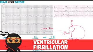 Rate and Rhythm  Ventricular Fibrillation [upl. by Nrev]