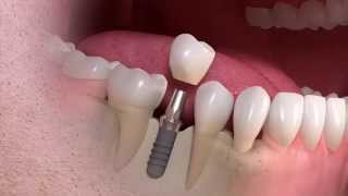 Straumann  Implantborne singletooth treatment [upl. by Ylrahc]