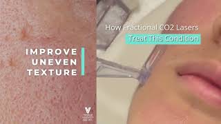 Fractional CO2 Laser Singapore  FAQ  Acne Scars Treatment [upl. by Yelah]