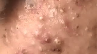 Huge Acne Pimples Blackheads Popping Up Satisfying with Oddly Calm Music [upl. by Polky]