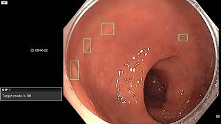 Multiple Polyp Detection with AI  Olympus ENDOAID Target Mode [upl. by Llehcor]