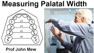 Measuring the Width of the Upper Jaw Palate Maxilla in Orthodontic Treatment by Prof John Mew [upl. by Blondy]