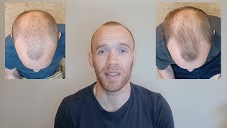 Rosemary Oil for Hair Growth  6 Month Results [upl. by Asaret]