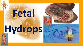 Fetal Hydrops  Hydrops Fetalis  Fetal Hydrops Causes Complications Treatment and Prognosis [upl. by Magel]