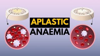 Aplastic Anaemia Causes Signs and Symptoms Diagnosis and Treatment [upl. by Dovev]