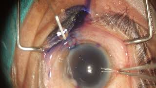 CAPSULASER Pseudoexfoliation with constricted pupil [upl. by Adiela]