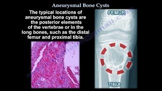 Aneurysmal Bone Cyst  Everything You Need To Know  Dr Nabil Ebraheim [upl. by Aromas250]