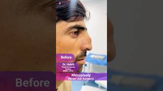 Rhinoplasty Transformation Before and After with Dr Habib [upl. by Williamsen762]