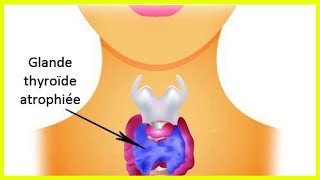 L’hypothyroïdie  comment prendre soin de sa thyroïde [upl. by Ioj]