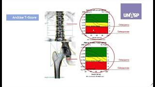 Densitometria óssea e osteoporose [upl. by Riccardo]