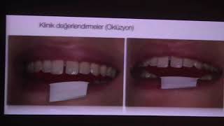 Minimal İnvazif Yöntemlerle Diastema Vakalarının tedavisi  ProfDr Uğur Erdemir [upl. by Ahsitan]