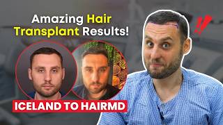 You Won’t Believe This Patient’s Results  Iceland Patient’s Hair Transplant Journey at HairMD [upl. by Leonhard]