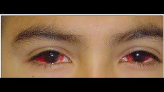 Pediatric Ophthalmology Lecture Preview [upl. by Connolly104]