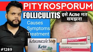 Fungal Acne का कारण और इलाज  Pityrosporum Folliculitis CauseSymptoms amp Treatment In Hindi [upl. by Meer]