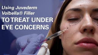 Using Juvederm Volbella® Filler To Treat UnderEye Concerns at ZO Skin Centre [upl. by Dougie814]