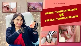 Normal tooth Extraction VS surgical tooth Extraction… [upl. by Anaiek]