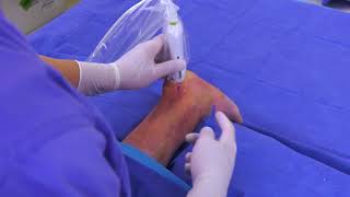 TenJet Achilles Tendon Minimally Invasive Tenotomy Procedure [upl. by Nosnevets]