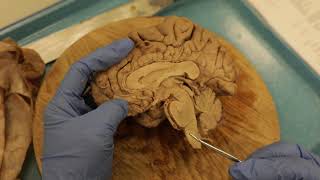 Sagittal Brain Dissection [upl. by Nepets]