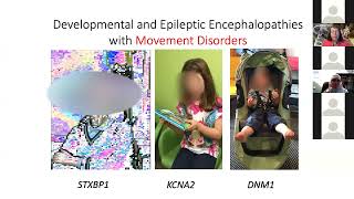 Developmental and Epileptic Encephalopathies AntiEpileptic Medications ILAE Mediterranean Webinar [upl. by Gare912]