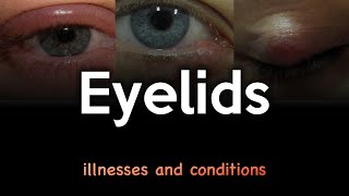 Eyelid Illnesses and Conditions [upl. by Man]