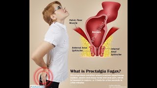 Proctalgia FUGAX 🔴ألم المستقيم العابر [upl. by Shira]