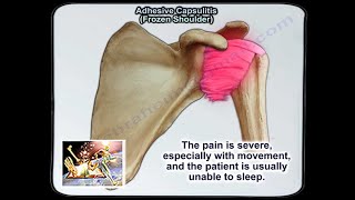 Adhesive Capsulitis Frozen Shoulder  Everything You Need To Know  Dr Nabil Ebraheim [upl. by Lambertson]