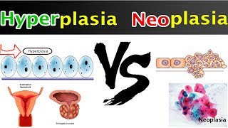 Neoplasia Vs Hyperplasia  Clear Comparison [upl. by Nymzaj]