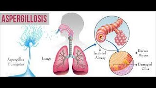 Aspergillosis  causes symptoms treatment  aspergillus fungal lung infection  aspergilloma [upl. by Attenal]