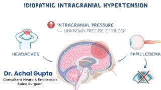 Idiopathic Intracranial Hypertension  Dr Achal Gupta  Neurosurgeon amp Endoscopic Spine Surgeon [upl. by Miza]