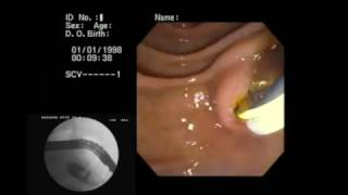 ERCP  CPRE  Extraccion de Litiasis  Litotricia [upl. by Olympe]