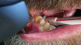 Easy Tooth Extraction  Dental Minute with Steven T Cutbirth DDS [upl. by Gilmour822]