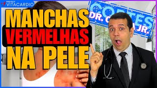 Tudo o que Você Deveria Saber Sobre Manchas Vermelhas na Pele e sua Relação com as Manchas Roxas [upl. by Marucci868]