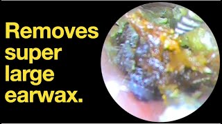 Removes super large earwax ear wax removal  ear cleaning  ASMR  relaxation  relax [upl. by Almire936]