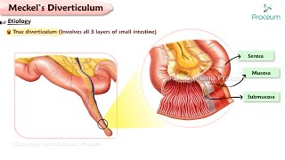 Meckel’s Diverticulum Etiology Clinical features Diagnosis Treatment Complications Surgery [upl. by Michelle]