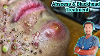 Abscess Treatment Causes Symptoms and Removalquot [upl. by Esylle807]