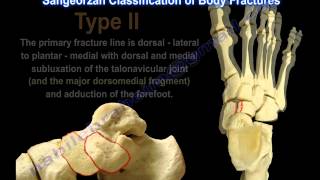 Navicular Fractures  Everything You Need To Know  Dr Nabil Ebraheim [upl. by Denzil]