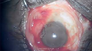 Pterygium excision with autograft By Dr K L Agrawal [upl. by Thackeray]