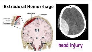 extradural hematoma  head trauma 1 headinjury [upl. by Risan]