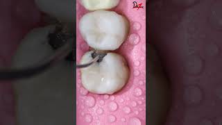 Satisfying Cavity Cleaning ASMR Dental [upl. by Pyne]