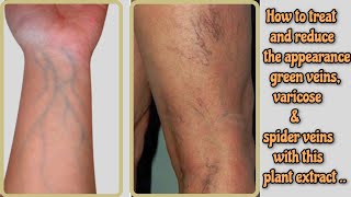 HOW TO TREAT GREEN VEINS VARICOSE amp SPIDER VEINS FAST FAST [upl. by Salisbarry]