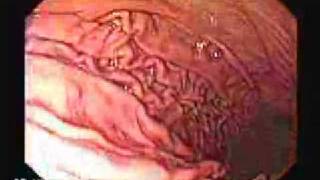 Acid Reflux Surgery  Video Endoscopy [upl. by Hassett907]