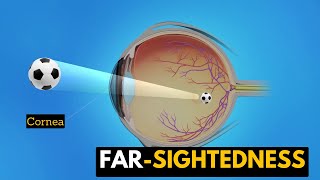 Farsightedness Causes Signs and Symptoms Diagnosis and Treatment [upl. by Imis]