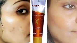 KojigloGOLD CREAM  kojiglo gold skin lightening cream  SHOPOHOLICHEENA kojicacid acne [upl. by Ojybbob661]