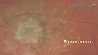 Stargardt Macular Dystrophy [upl. by Ahsitul334]