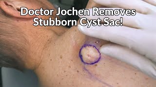 Entire Cyst Sac Removed from Patients Back  CONTOUR DERMATOLOGY [upl. by Aoniak]