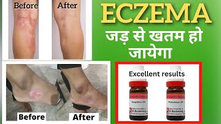 homeopathic treatment of eczema eczema ka jad se ilaj  eczema permanent cure [upl. by Cath]