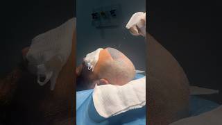 Vinci Hair transplant masterclass 5000 grafts FUE HT vincihairclinic shorts [upl. by Perkin]